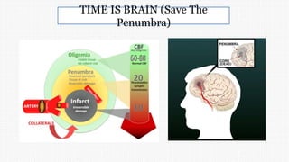 TIME IS BRAIN (Save The
Penumbra)
 