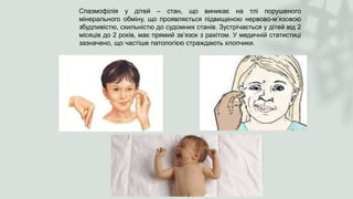 Спазмофілія у дітей – стан, що виникає на тлі порушеного
мінерального обміну, що проявляється підвищеною нервово-м’язовою
збудливістю, схильністю до судомних станів. Зустрічається у дітей від 2
місяців до 2 років, має прямий зв’язок з рахітом. У медичній статистиці
зазначено, що частіше патологією страждають хлопчики.
 