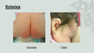 Клініка
• Еритема • Гнейс
 
