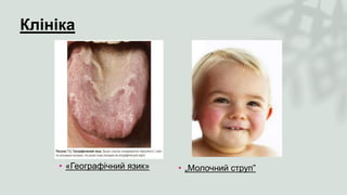 Клініка
• «Географічний язик» • „Молочний струп”
 