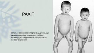 РАХІТ
• загальне захворювання організму дитини, що
виникає внаслідок екзогенного дефіциту
вітаміну Д або порушення його природного
синтезу в організмі.
 