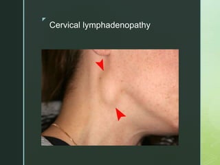 z
Cervical lymphadenopathy
 