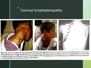 z
Cervical lymphadenopathy
 