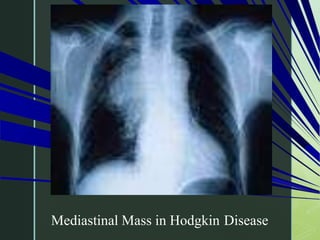 Mediastinal Mass in Hodgkin Disease
 