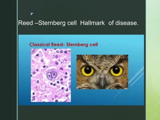 z
Reed –Sternberg cell Hallmark of disease.
 