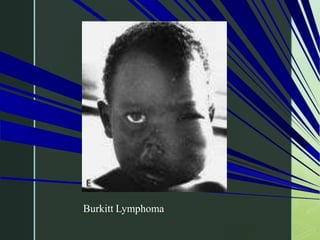 Burkitt Lymphoma
 