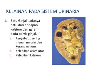 KELAINAN PADA SISTEM URINARIA
1. Batu Ginjal : adanya
batu dari endapan
kalsium dan garam
pada pelvis ginjal.
a. Penyebab : sering
menaham urin dan
kurang minum
b. Kelebihan asam urat
c. Kelebihan kalsium
 