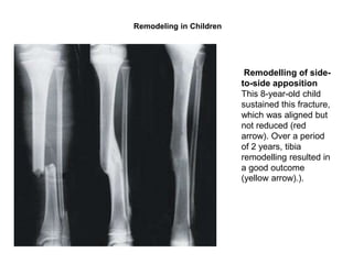 Remodelling Tibia Principles, pitfalls & problems of Paediatrics Fractures AKU 2023.pptx