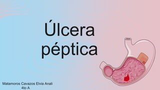 Matamoros Cavazos Elvia Anali
4to A
Úlcera
péptica
 