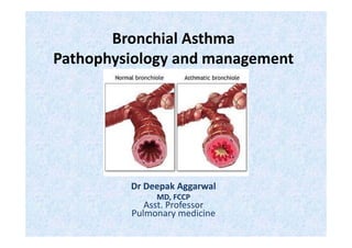 Bronchial Asthma
Pathophysiology and management
Dr Deepak Aggarwal
MD, FCCP
Asst. Professor
Pulmonary medicine
 