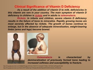 Clinical Significance of Vitamin D Deficiency
As a result of the addition of vitamin D to milk, deficiencies in
this vitamin are rare in your country. The main symptom of vitamin D
deficiency in children is rickets and in adults is osteomalacia.
Rickets: In infants and children, severe vitamin D deficiency
results in the failure of bone to mineralize. Rapidly growing bones are
most severely affected by rickets. The growth of bones continue to
enlarge, but in the absence of adequate mineralization, weight-bearing
limbs (arms and legs) become bowed.
Osteomalacia is characterized by
demineralization of previously formed bone leading to
increased softness and susceptibility to fracture.
https://lh3.googleusercontent.com/C8QBjdEWKngjkumPK14tcn17GWiYf11C-OsiUzjEZr7TDl58m_7KjTObikl1UeP8Vg4gYSk=s85
https://lh3.googleusercontent.com/hGjSx1UPtiFTQQRjIJYg5-CFZlIbaekndRml2h0ZPgkUZ8fY2EZtXXVZIaHyN_SCW28a=s85
 