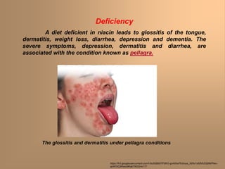 Deficiency
A diet deficient in niacin leads to glossitis of the tongue,
dermatitis, weight loss, diarrhea, depression and dementia. The
severe symptoms, depression, dermatitis and diarrhea, are
associated with the condition known as pellagra.
The glossitis and dermatitis under pellagra conditions
https://lh3.googleusercontent.com/t-8u0QB93TP2KO-gnAtGw7Edmpa_X25x1x5ZkfrZQ28iiPNsv-
qoWOiCjWoocdlKabTKDQ=s117
 