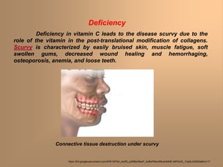 Deficiency
Deficiency in vitamin C leads to the disease scurvy due to the
role of the vitamin in the post-translational modification of collagens.
Scurvy is characterized by easily bruised skin, muscle fatigue, soft
swollen gums, decreased wound healing and hemorrhaging,
osteoporosis, anemia, and loose teeth.
Connective tissue destruction under scurvy
https://lh3.googleusercontent.com/4FlE1SPXA_nanfD_szR8tbUftswF_AxBlxPMeJNRuaHbINE-k6PGmE_-FqsSJzXSK5aM=s117
 