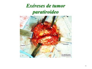 Exéreses de tumor
paratiroideo
36
 