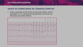 ELETROCARDIOGRAMA
SINAIS DE SOBRECARGA DE CÂMARAS DIREITAS
੦ onda p apiculada em DII, desvio do eixo para direita, onda R
apiculada em V1 e alteração da repolarização ventricular nas
derivações precordiais direitas
 