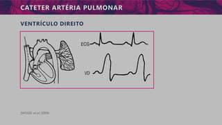 CATETER ARTÉRIA PULMONAR
VENTRÍCULO DIREITO
(MCGEE et al, 2009)
 