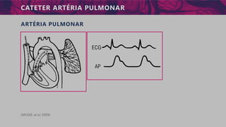 CATETER ARTÉRIA PULMONAR
ARTÉRIA PULMONAR
(MCGEE et al, 2009)
 