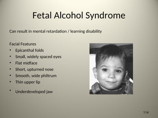 Fetal Alcohol Syndrome
Can result in mental retardation / learning disability
Facial Features
• Epicanthal folds
• Small, widely spaced eyes
• Flat midface
• Short, upturned nose
• Smooth, wide philtrum
• Thin upper lip
• Underdeveloped jaw
114
 