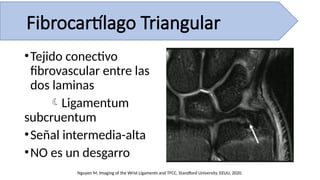 •Tejido conectivo
fibrovascular entre las
dos laminas
Ligamentum
subcruentum
•Señal intermedia-alta
•NO es un desgarro
Nguyen M, Imaging of the Wrist Ligaments and TFCC, Standford University, EEUU, 2020.
Fibrocartílago Triangular
 