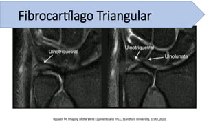 Nguyen M, Imaging of the Wrist Ligaments and TFCC, Standford University, EEUU, 2020.
Fibrocartílago Triangular
 