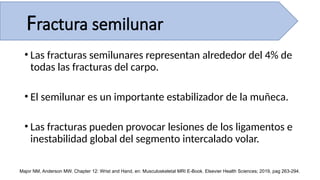 • Las fracturas semilunares representan alrededor del 4% de
todas las fracturas del carpo.
• El semilunar es un importante estabilizador de la muñeca.
• Las fracturas pueden provocar lesiones de los ligamentos e
inestabilidad global del segmento intercalado volar.
Major NM, Anderson MW. Chapter 12: Wrist and Hand, en: Musculoskeletal MRI E-Book. Elsevier Health Sciences; 2019, pag 263-294.
Fractura semilunar
 
