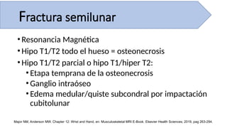 •Resonancia Magnética
•Hipo T1/T2 todo el hueso = osteonecrosis
•Hipo T1/T2 parcial o hipo T1/hiper T2:
•Etapa temprana de la osteonecrosis
•Ganglio intraóseo
•Edema medular/quiste subcondral por impactación
cubitolunar
Major NM, Anderson MW. Chapter 12: Wrist and Hand, en: Musculoskeletal MRI E-Book. Elsevier Health Sciences; 2019, pag 263-294.
Fractura semilunar
 