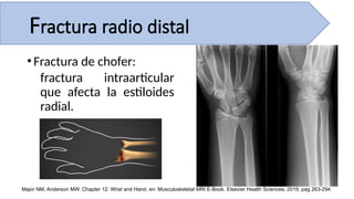 •Fractura de chofer:
fractura intraarticular
que afecta la estiloides
radial.
Major NM, Anderson MW. Chapter 12: Wrist and Hand, en: Musculoskeletal MRI E-Book. Elsevier Health Sciences; 2019, pag 263-294.
Fractura radio distal
 