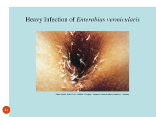 Adult Pinworms on the perianal skin
41
 