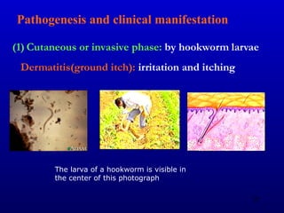 Pathogenesis and clinical manifestation
(1) Cutaneous or invasive phase: by hookworm larvae
Dermatitis(ground itch): irritation and itching
The larva of a hookworm is visible in
the center of this photograph
61
 