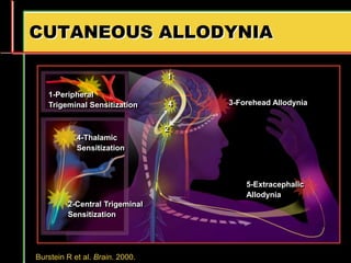 CUTANEOUS ALLODYNIA
Burstein R et al. Brain. 2000.
1-Peripheral
Trigeminal Sensitization
2-Central Trigeminal
Sensitization
3-Forehead Allodynia
4-Thalamic
Sensitization
5-Extracephalic
Allodynia
1
4
2
 