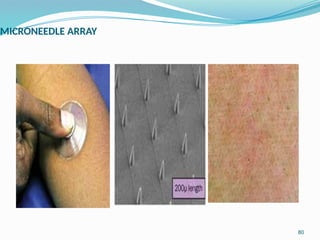 MICRONEEDLE ARRAY
80
 