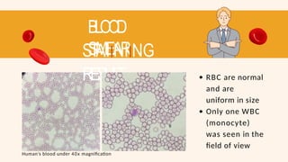 BLOOD
SMEAR
STAIINIING
RESUL
T RBC are normal
and are
uniform in size
Only one WBC
(monocyte)
was seen in the
field of view
Human’s blood under 40x magnification
 