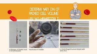 DETERMIINATIION OF
P
ACKED CELL VOLUME
USIING HEMATOCRIIT
METHOD
- a
- b
- c
c) Erythrocytes
a) Plasma, b) Buffy coat; Heamatocrit reader.
a
b
c
d
e
f
c. Centrifuged human blood with
39% PCV
 