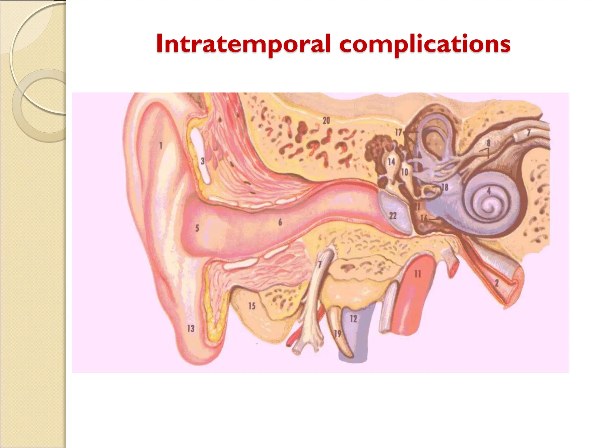 Intratemporal complications
 