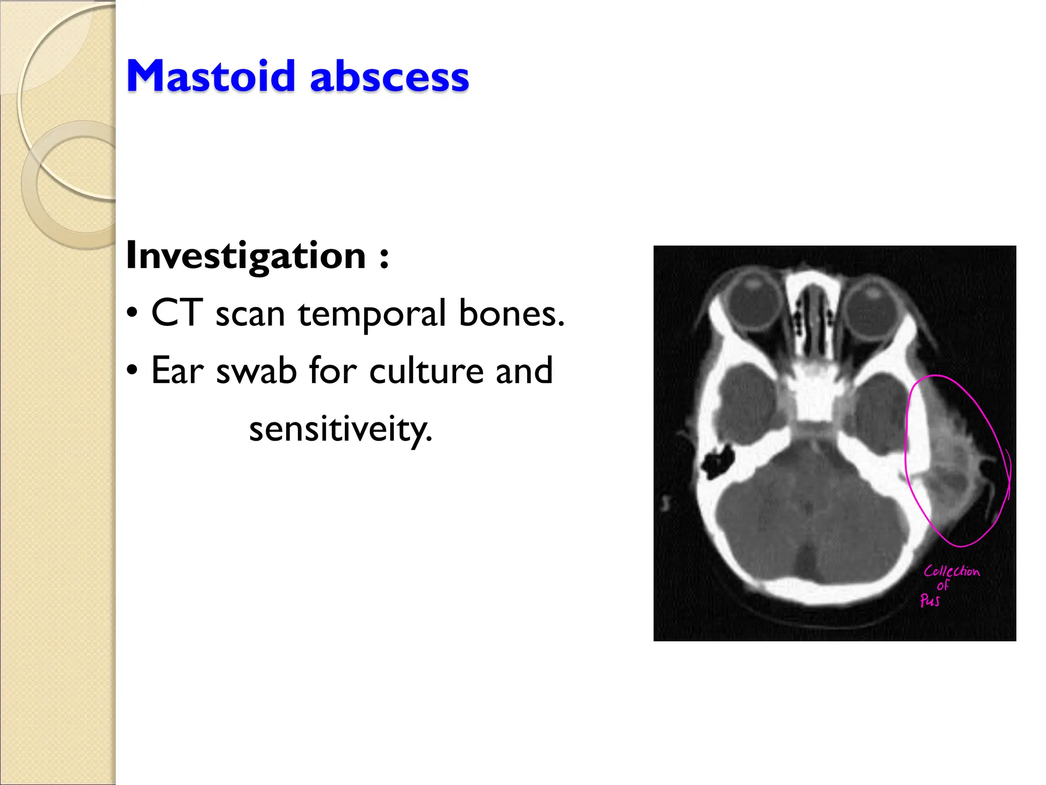 Mastoid abscess
Investigation :
CT scan emporal bones.
Ear s ab for c l re and
sensitiveity.
0
Collection
of
Pus
 