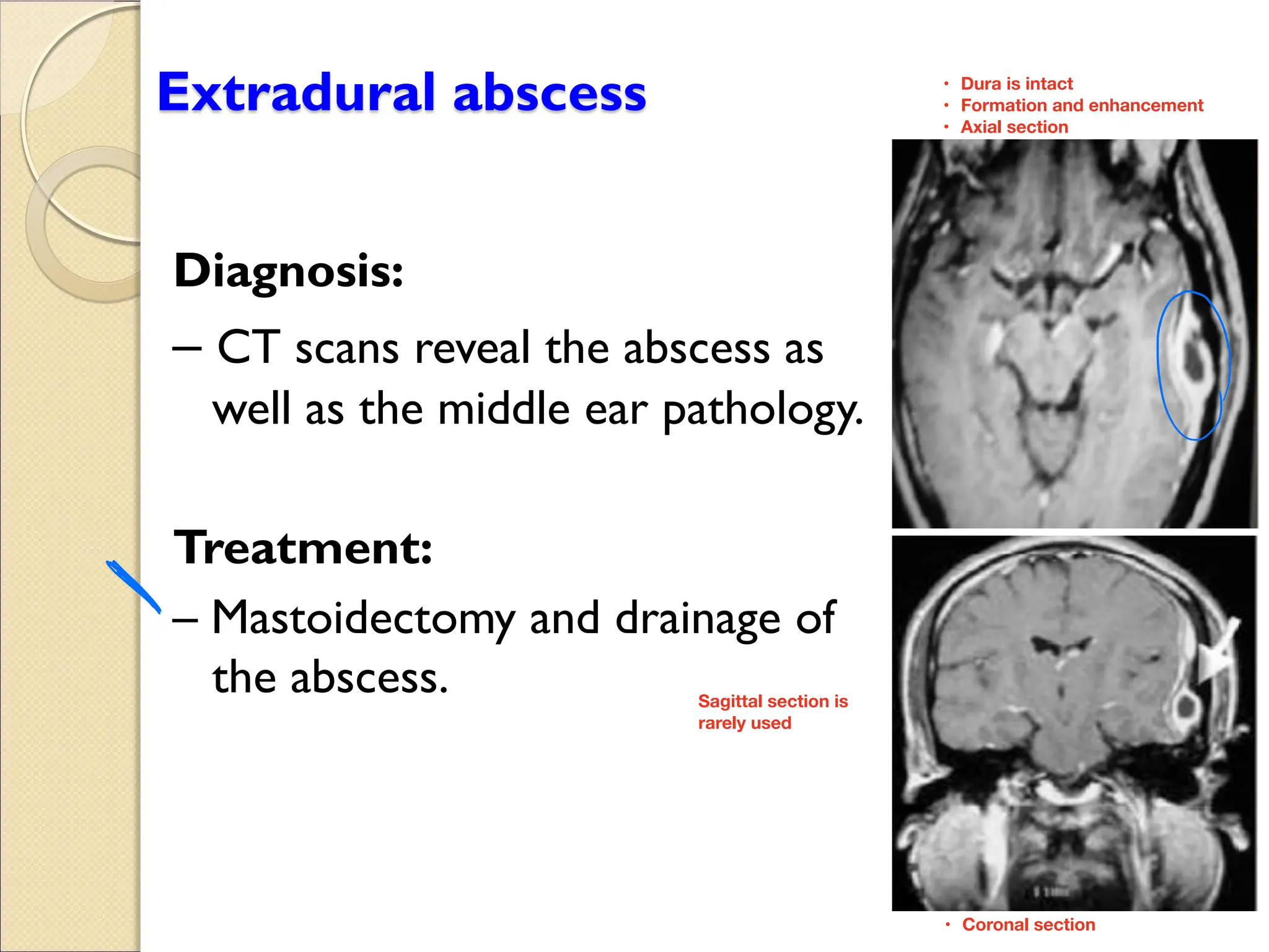 Extradural abscess
Diagnosis:
CT scans reveal the abscess as
well as the middle ear pathology.
Treatment:
Mastoidectomy and drainage of
the abscess.
o
Dura is intact
•
Formation and enhancement
•
Axial section
•
Coronal section
•
Sagittal section is
rarely used
 