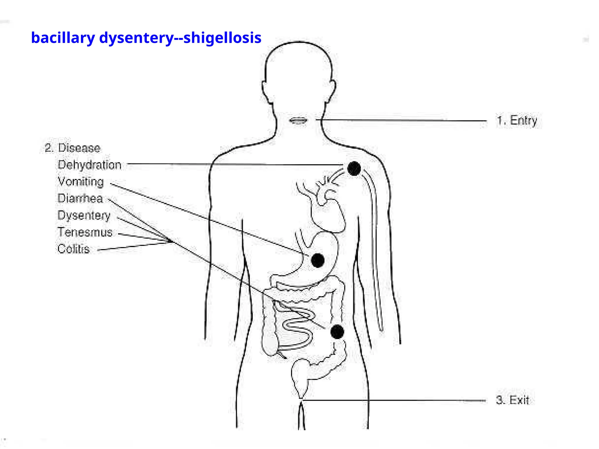 bacillary dysentery--shigellosis
 