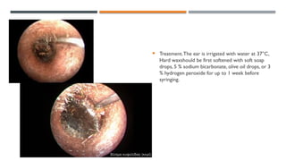 Soap In Ear 5. External ear.pptx anatomy pathophsyio diseas | PPTX