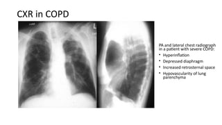 Chrinic obstructive pulmonary diseaase powerpoint | PPTX