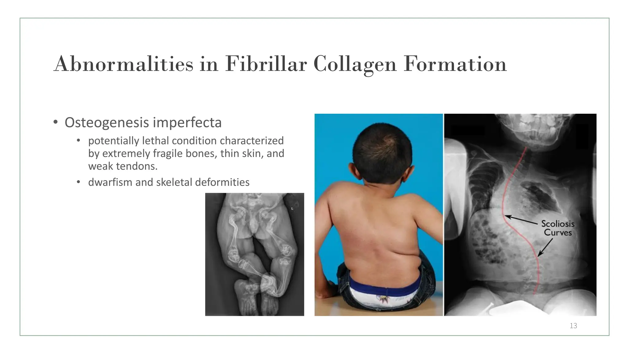 Abnormalities in Fibrillar Collagen Formation
13
• Osteogenesis imperfecta
• potentially lethal condition characterized
by extremely fragile bones, thin skin, and
weak tendons.
• dwarfism and skeletal deformities
 
