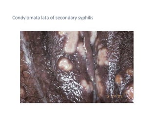 Comprehensive Overview of Sexually Transmitted Infections (STIs) and ...