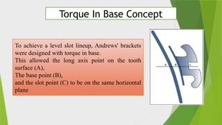 Comprehensive Overview of MBT Orthodontic Philosophy and Appliance ...
