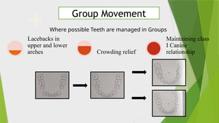 Comprehensive Overview of MBT Orthodontic Philosophy and Appliance ...