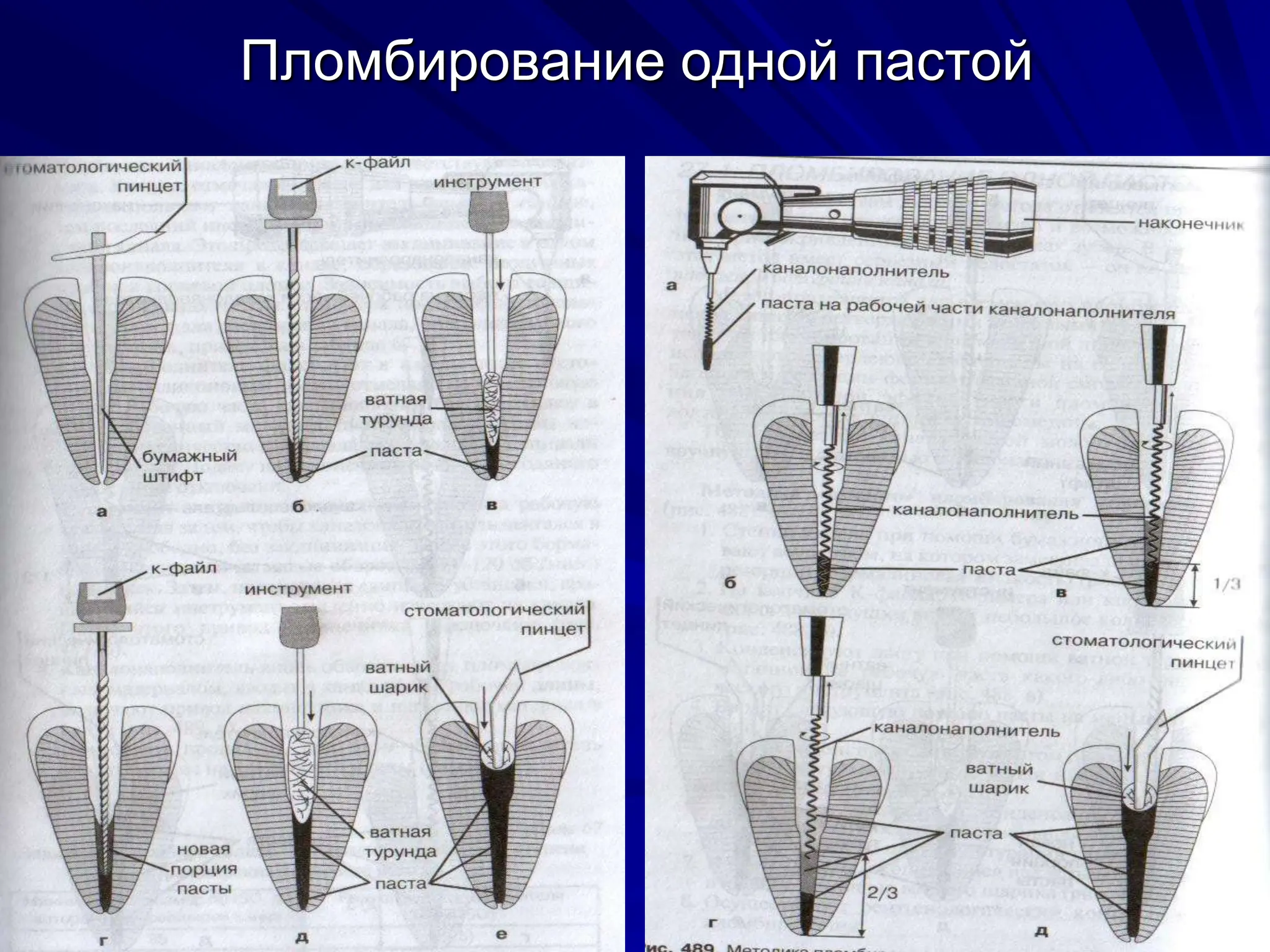 Пломбирование одной пастой
 