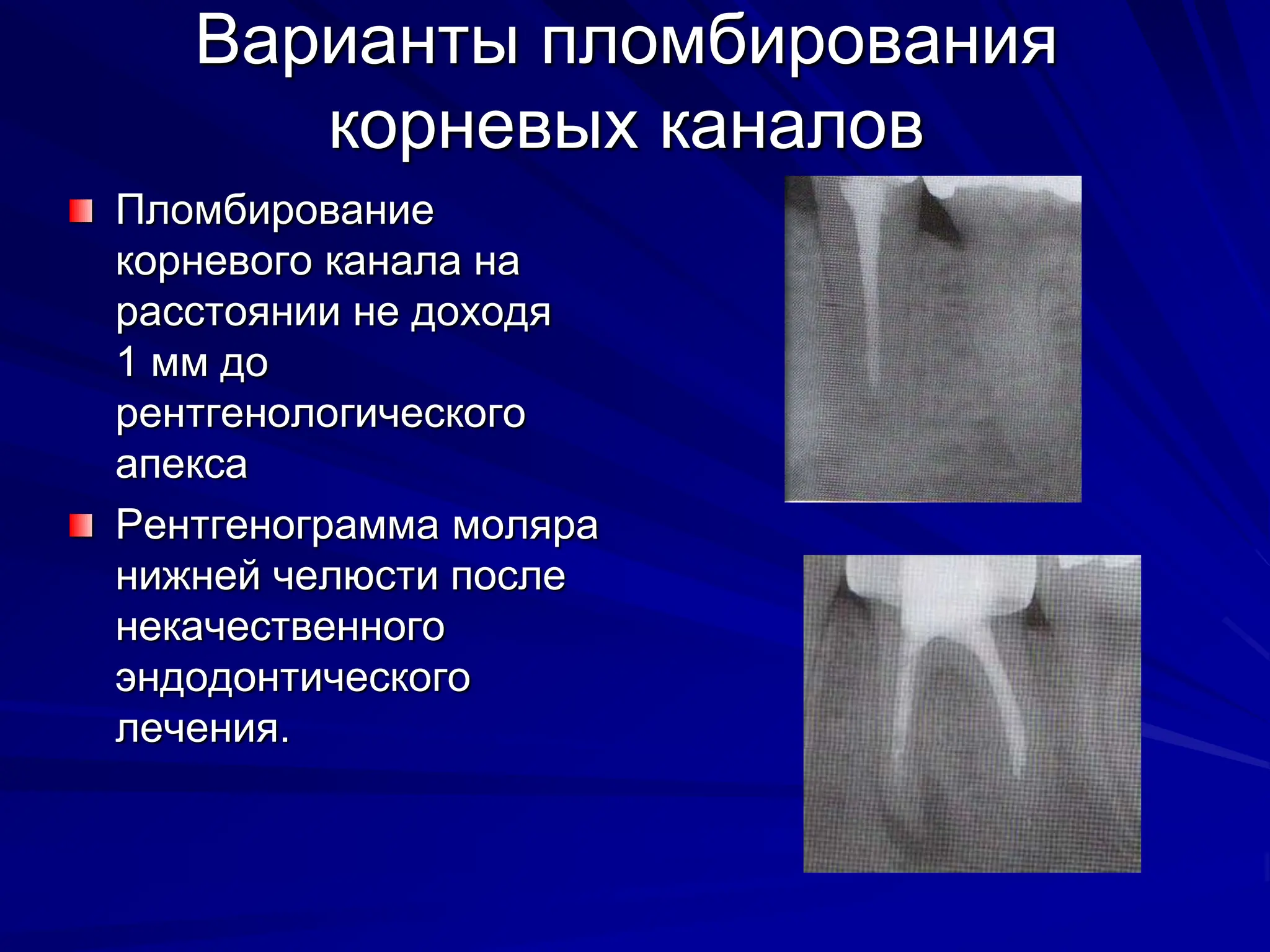 Варианты пломбирования
корневых каналов
Пломбирование
корневого канала на
расстоянии не доходя
1 мм до
рентгенологического
апекса
Рентгенограмма моляра
нижней челюсти после
некачественного
эндодонтического
лечения.
 