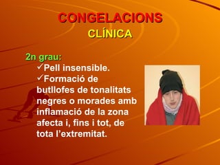 2n grau: Pell insensible. Formació de butllofes de tonalitats negres o morades amb inflamació de la zona afecta i, fins i tot, de tota l’extremitat. CLÍNICA CONGELACIONS 
