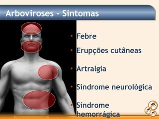 • Febre
• Erupções cutâneas
• Artralgia
• Síndrome neurológica
• Síndrome
hemorrágica
Arboviroses - Sintomas
 