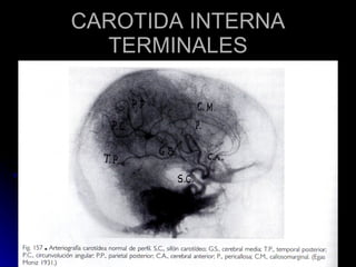 CAROTIDA INTERNA TERMINALES 