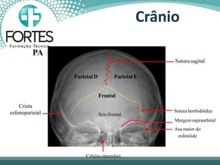 Parietal D Parietal E
Frontal
Crista
esfenoparietal
Sutura sagital
Sutura lambidóidea
Seio frontal
Margemsupraorbital
Asa maior do
esfenóide
Células etmoidais
PA
Crânio
 