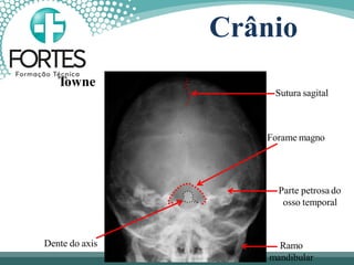 Sutura sagital
Forame magno
Parte petrosa do
osso temporal
Ramo
mandibular
Dente do axis
Towne
Crânio
 